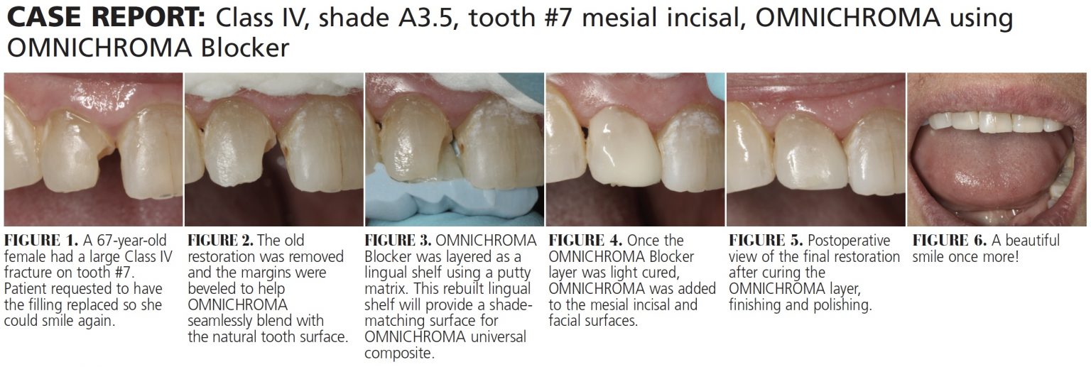 Universal Composite Saves Time, Simplifies Shade Matching Decisions