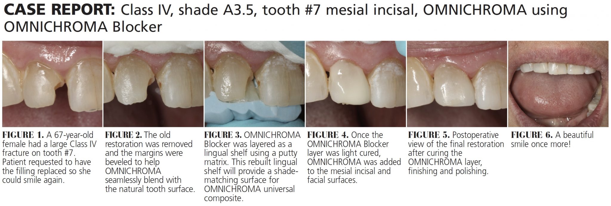 Universal Composite Saves Time, Simplifies Shade Matching Decisions