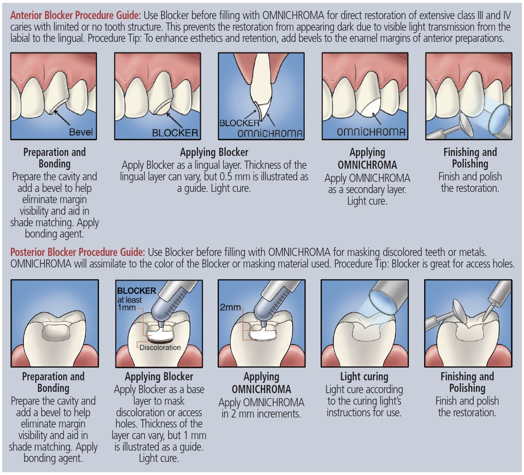 What Is Composite Filling? A Guide