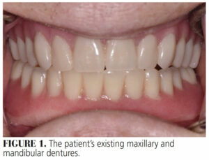 FIGURE 1. The patient’s existing maxillary and mandibular dentures.