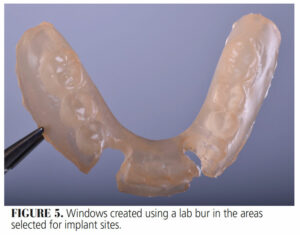 FIGURE 5. Windows created using a lab bur in the areas selected for implant sites.