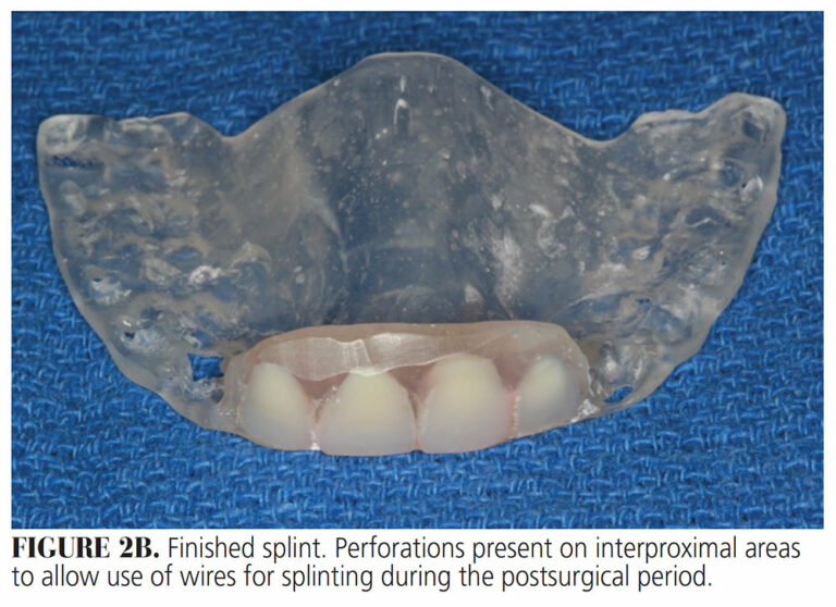 Easy Method for Esthetic Postsurgical Splint Fabrication Decisions in