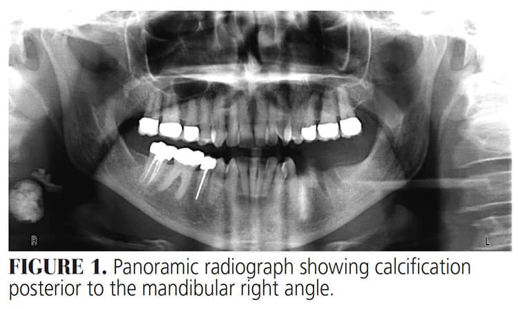 Diagnosing Incidental Thyroid Calcifications On Dental Images