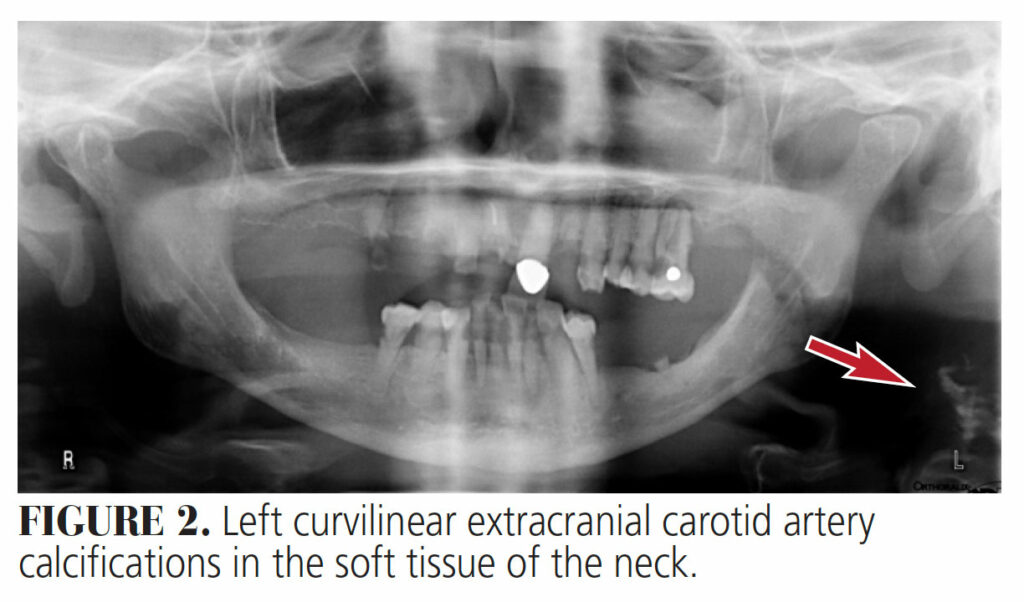 FIGURE 2. Left curvilinear extracranial carotid artery calcifications in the soft tissue of the neck.