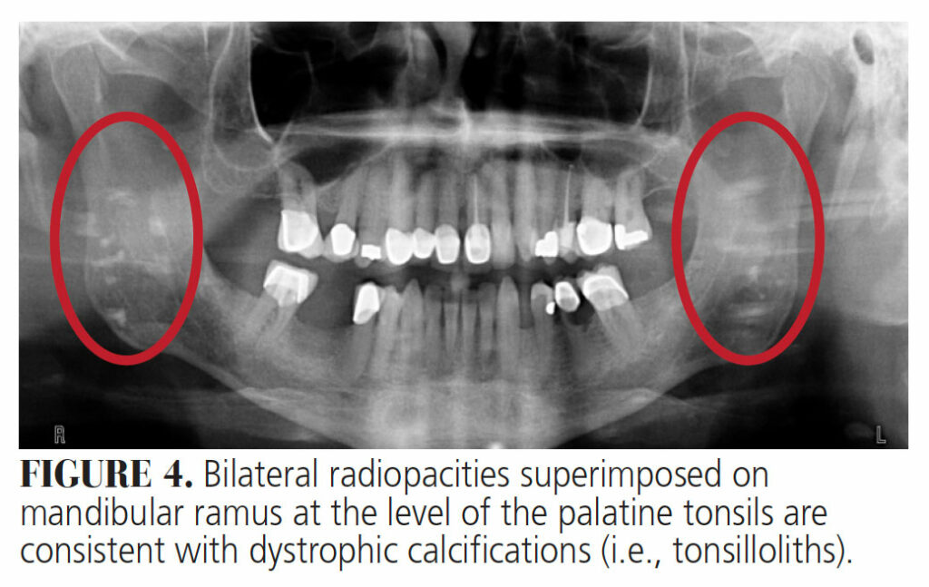 Diagnosing Incidental Thyroid Calcifications on Dental Images