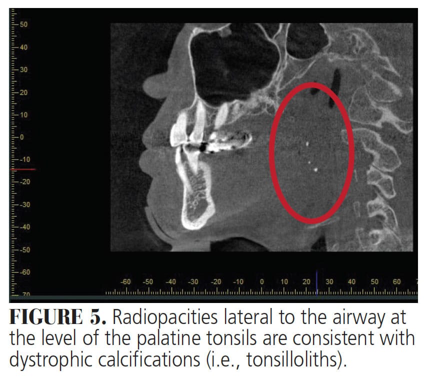 thyroid cartilage xray