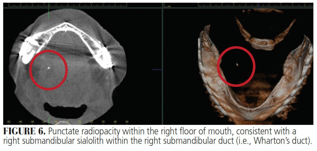 FIGURE 6. Punctate radiopacity within the right floor of mouth, consistent with a right submandibular sialolith within the right submandibular duct (i.e., Wharton’s duct).