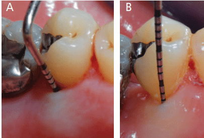 Clinical lingual aspect before nonsurgical periodontal instrumentation