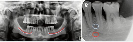 mental nerve foramen