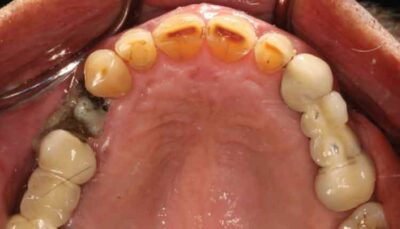 FIGURES 1A and 1B. Intraoral photographs show bone exposure