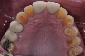 Dental erosion