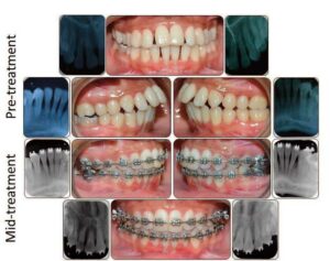 Case report involving a female with orthodontic concerns