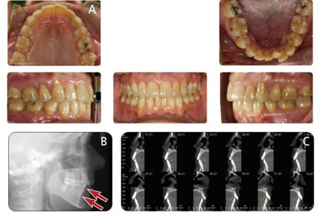 Is orthodontic treatment painful? - Clínica Blasi