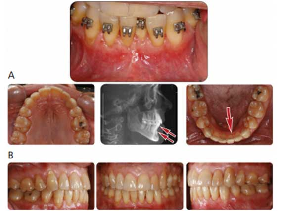 Exploring the Orthodontic Periodontic Relationship - Decisions in Dentistry