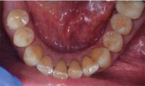 Wear visible on incisal and occlusal surface