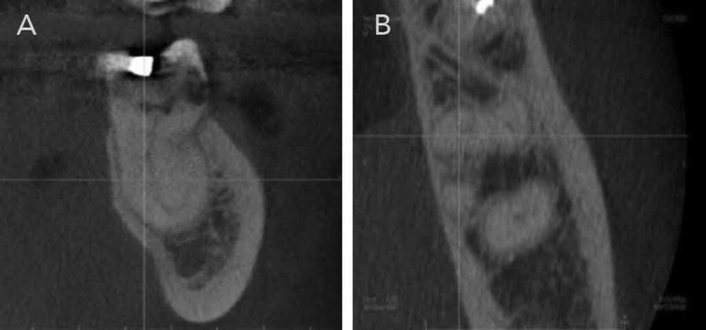 FIGURES 3A and 3B. Mesial root bifurcation towards lingual (A and B)