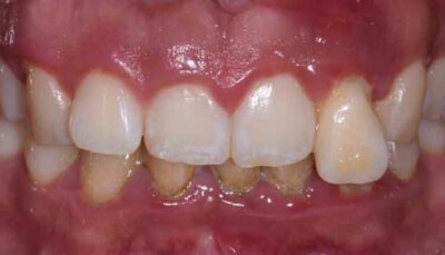 close up of front teeth