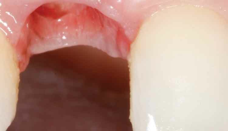 Resin Bonded Bridge: Minimally Invasive Option for Tooth Replacement - Shor  Dental