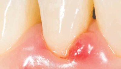 gingival crevicular