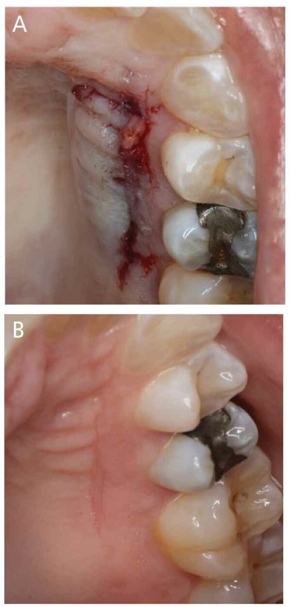 Applications for Platelet Rich Fibrin in Dentistry Decisions in Dentistry