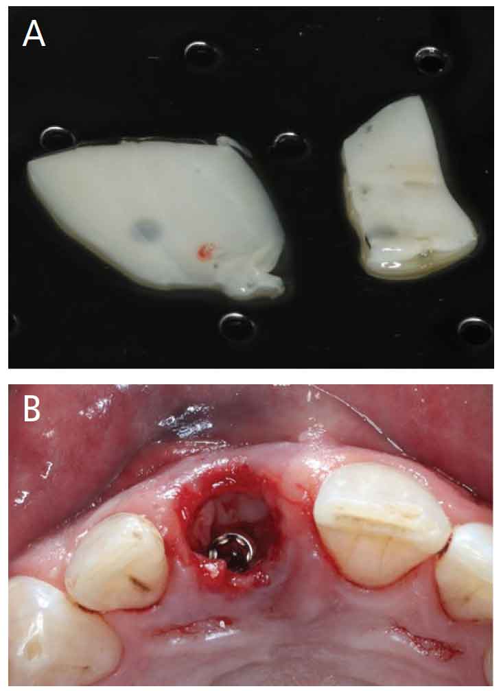 Applications For Platelet Rich Fibrin In Dentistry Decisions In Dentistry