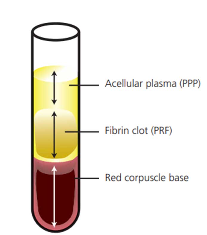 The Power of Platelet-Rich Fibrin - Dimensions of Dental Hygiene