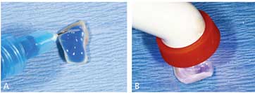 Immediate Implant Placement and Provisionalization in the Esthetic Zone ...