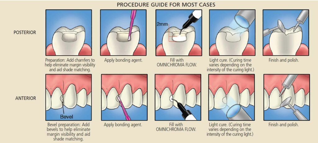 PROCEDURE GUIDE FOR MOST CASES