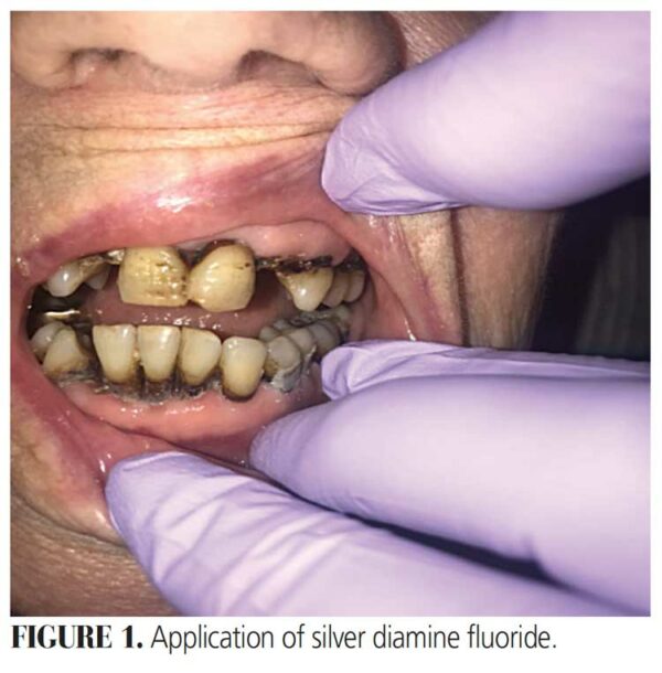Minimizing Aerosols in Dental Practice Decisions in Dentistry