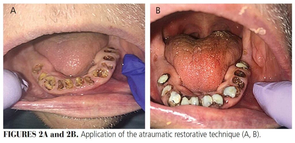 FIGURES 2A and 2B. Application of the atraumatic restorative technique (A, B).