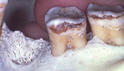 Treatment Approaches to Periodontally Furcated MANDIBULAR MOLARS