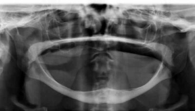 Clinical Utility OfSHORT DENTAL IMPLANTS