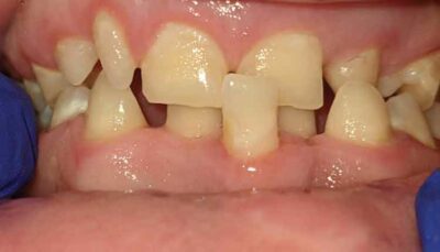 Oral Health Considerations For PATIENTS WITH DOWN SYNDROME