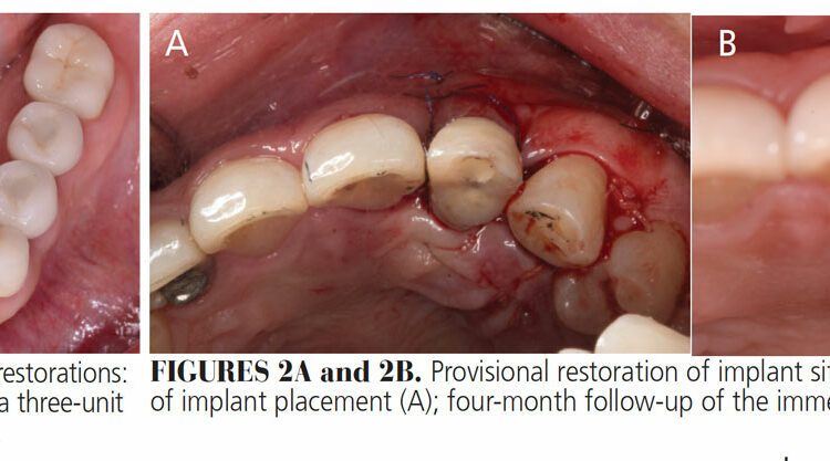 0621-did-implant-restorations-1