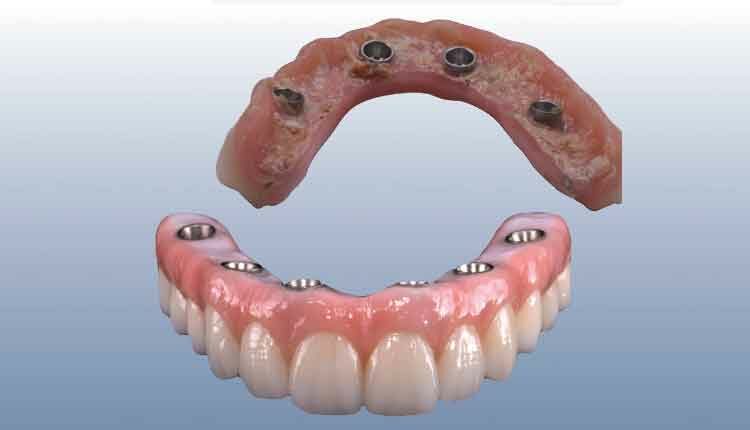 Managing Complications from Ill Fitting Dentures