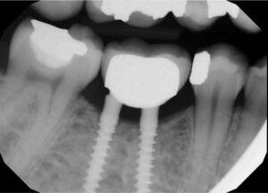 FIGURE 2. Periapical radiograph of site #30 taken six months (June 2014) after placing the two mini-implants and restoration.