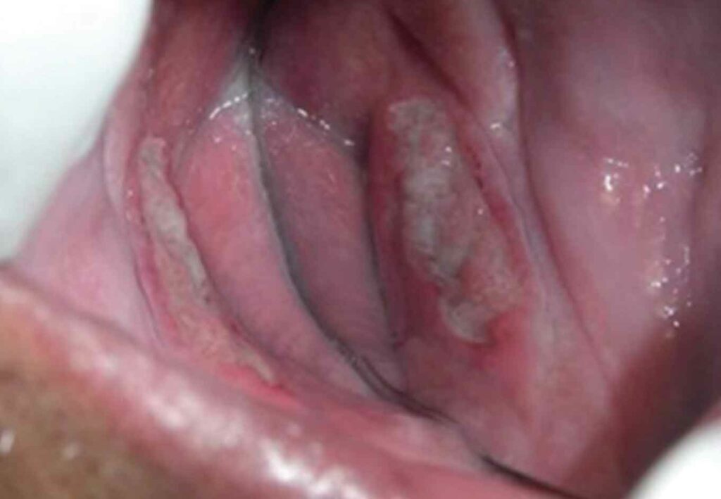 FIGURE 1. Oral tuberculosis lesion.