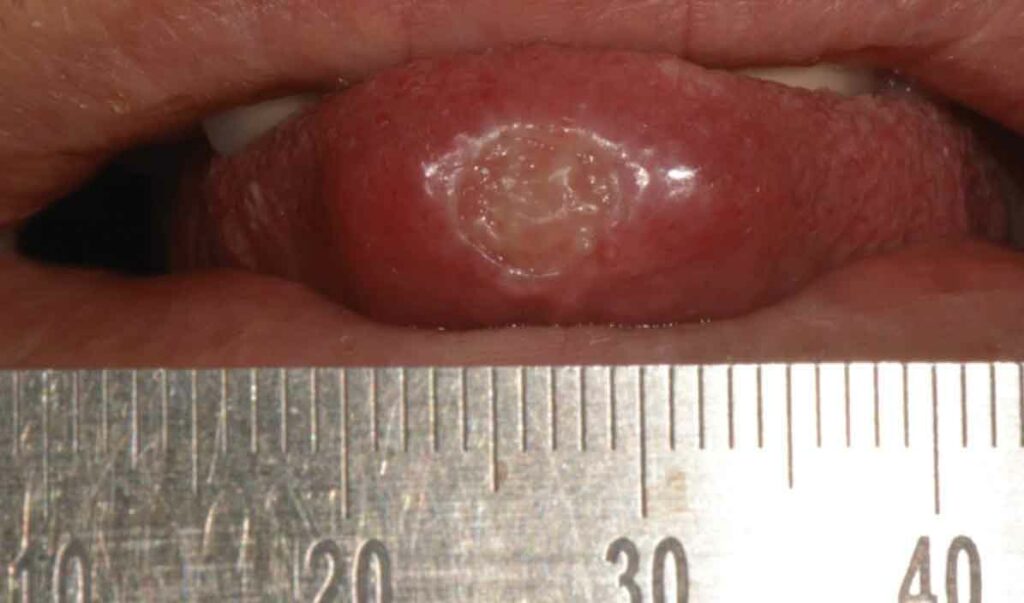 FIGURE 2. Tuberculosis lesion on tip of the tongue.