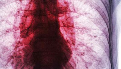 xray of lungs