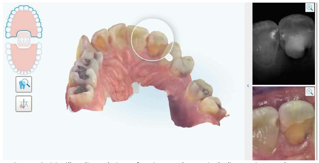 FIGURE 3. Maxillary lingual view of an intraoral scan, including an intraoral photograph and near-infrared imaging.
