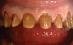 FIGURE 3. Tooth preparation of teeth #5 to 12.