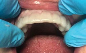 FIGURE 5. Intraoral placement of stent.