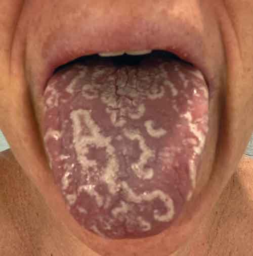 geographic tongue baby