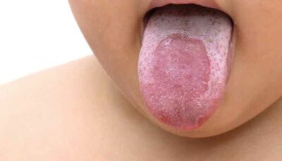 close up of geographic tongue