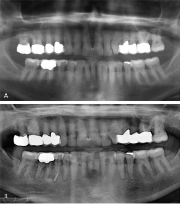 Managing Xerostomia During Cancer Therapy Decisions in Dentistry