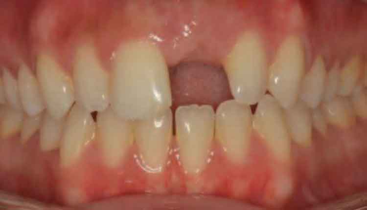 implant placement