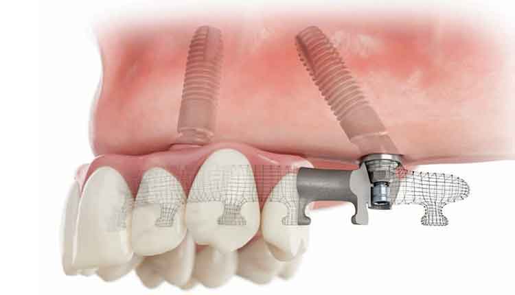 implants