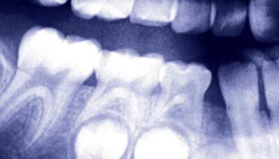 xray of teeth