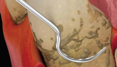 3D Graphic of teeth getting cleaning