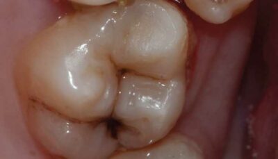 supernumerary and ectopic teeth